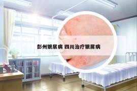 彭州銀屑病 四川治療銀屑病