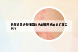 頭部銀屑病專科醫(yī)院 頭部銀屑病自愈的真實例子