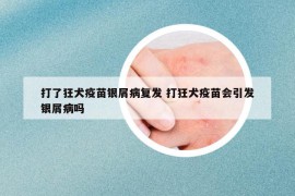 打了狂犬疫苗銀屑病復(fù)發(fā) 打狂犬疫苗會引發(fā)銀屑病嗎