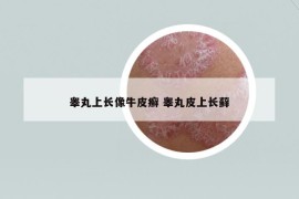 睪丸上長(zhǎng)像牛皮癬 睪丸皮上長(zhǎng)蘚