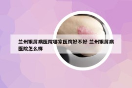 蘭州銀屑病醫(yī)院哪家醫(yī)院好不好 蘭州銀屑病醫(yī)院怎么樣