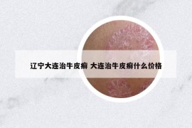 遼寧大連治牛皮癬 大連治牛皮癬什么價格