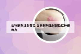 生物制劑注射部位 生物制劑注射部位紅腫癢咋辦