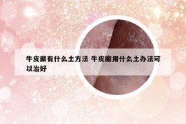 牛皮廨有什么土方法 牛皮廨用什么土辦法可以治好