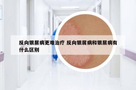 反向銀屑病更難治療 反向銀屑病和銀屑病有什么區(qū)別