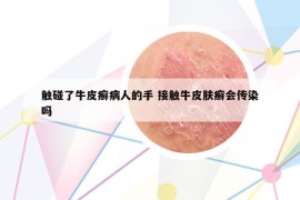 觸碰了牛皮癬病人的手 接觸牛皮膚癬會(huì)傳染嗎
