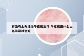 有沒有土辦法治牛皮廨治療 牛皮廨用什么土辦法可以治好