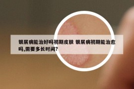 銀屑病能治好嗎初期皮膚 銀屑病初期能治愈嗎,需要多長時間?