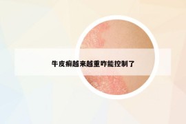 牛皮癬越來越重咋能控制了