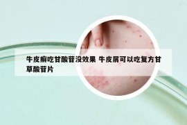 牛皮癬吃甘酸苷沒效果 牛皮屑可以吃復(fù)方甘草酸苷片
