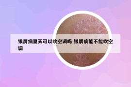 銀屑病夏天可以吹空調(diào)嗎 銀屑病能不能吹空調(diào)