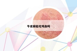 牛皮癬能吃雞血嗎