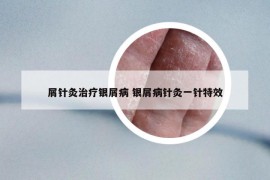 屑針灸治療銀屑病 銀屑病針灸一針特效