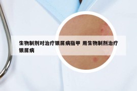 生物制劑對(duì)治療銀屑病指甲 用生物制劑治療銀屑病