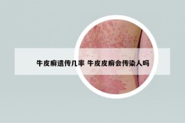 牛皮癬遺傳幾率 牛皮皮癬會(huì)傳染人嗎