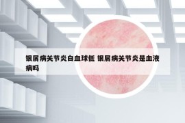 銀屑病關節(jié)炎白血球低 銀屑病關節(jié)炎是血液病嗎
