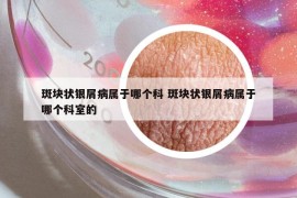 斑塊狀銀屑病屬于哪個科 斑塊狀銀屑病屬于哪個科室的