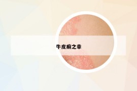 牛皮癬之幸