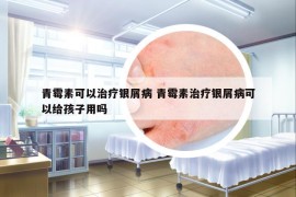青霉素可以治療銀屑病 青霉素治療銀屑病可以給孩子用嗎