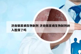 濟(jì)南銀屑病生物制劑 濟(jì)南銀屑病生物制劑納入醫(yī)保了嗎