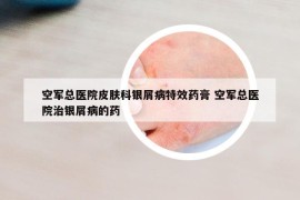 空軍總醫(yī)院皮膚科銀屑病特效藥膏 空軍總醫(yī)院治銀屑病的藥