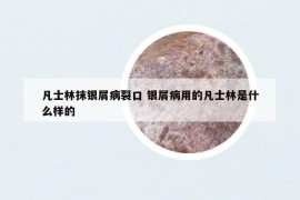 凡士林抹銀屑病裂口 銀屑病用的凡士林是什么樣的