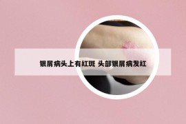 銀屑病頭上有紅斑 頭部銀屑病發(fā)紅