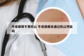 牛皮癬算不算傷口 牛皮膚癬會通過傷口傳染嗎