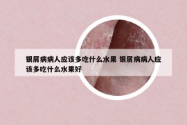 銀屑病病人應(yīng)該多吃什么水果 銀屑病病人應(yīng)該多吃什么水果好