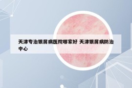 天津專治銀屑病醫(yī)院哪家好 天津銀屑病防治中心