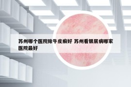 蘇州哪個醫(yī)院除牛皮癬好 蘇州看銀屑病哪家醫(yī)院最好