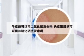 牛皮癬可以用二氧化硒洗頭嗎 頭皮銀屑病可以用二硫化硒洗發(fā)水嗎