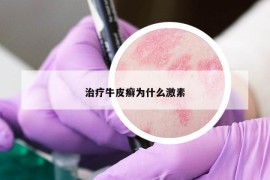 治療牛皮癬為什么激素