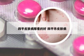 四平皮膚病那看的好 四平市皮膚病