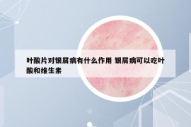 葉酸片對(duì)銀屑病有什么作用 銀屑病可以吃葉酸和維生素