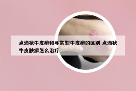 點滴狀牛皮癬和尋常型牛皮癬的區(qū)別 點滴狀牛皮膚癬怎么治療