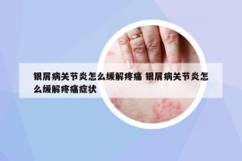 銀屑病關(guān)節(jié)炎怎么緩解疼痛 銀屑病關(guān)節(jié)炎怎么緩解疼痛癥狀