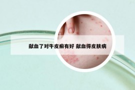 獻(xiàn)血了對(duì)牛皮癬有好 獻(xiàn)血得皮膚病