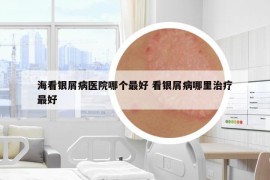 ?？淬y屑病醫(yī)院哪個(gè)最好 看銀屑病哪里治療最好