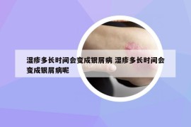 濕疹多長(zhǎng)時(shí)間會(huì)變成銀屑病 濕疹多長(zhǎng)時(shí)間會(huì)變成銀屑病呢