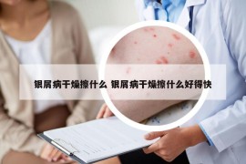銀屑病干燥擦什么 銀屑病干燥擦什么好得快