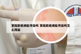 掌跖膿皰病能傳染嗎 掌跖膿皰病能傳染嗎怎么傳染