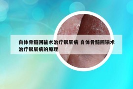 自體骨髓回輸術(shù)治療銀屑病 自體骨髓回輸術(shù)治療銀屑病的原理