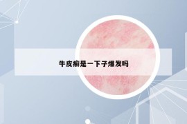 牛皮癬是一下子爆發(fā)嗎