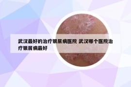 武漢最好的治療銀屑病醫(yī)院 武漢哪個醫(yī)院治療銀屑病最好
