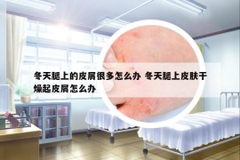 冬天腿上的皮屑很多怎么辦 冬天腿上皮膚干燥起皮屑怎么辦