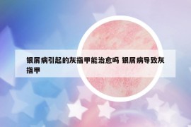 銀屑病引起的灰指甲能治愈嗎 銀屑病導(dǎo)致灰指甲