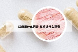 紅癬用什么藥膏 紅癬涂什么藥膏