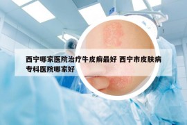 西寧哪家醫(yī)院治療牛皮癬最好 西寧市皮膚病專科醫(yī)院哪家好
