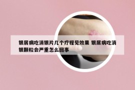 銀屑病吃消銀片幾個療程見效果 銀屑病吃消銀顆粒會嚴重怎么回事